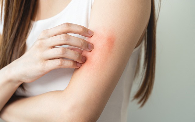 Frau mit gerötetem Hautausschlag am Arm